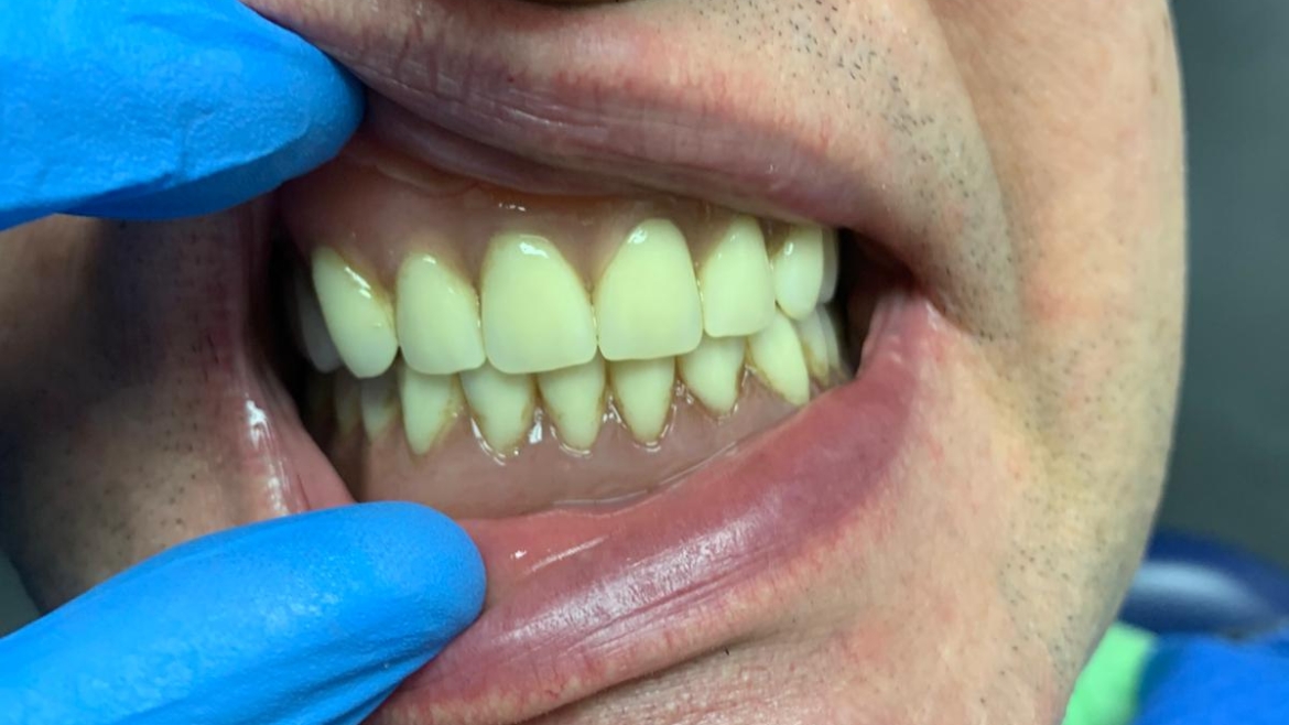 Sangue dalle gengive: quando preoccuparsi